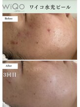 デイジー91(Daisy 91)/WIQo水光ピール導入します