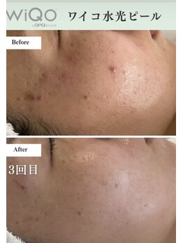 デイジー91(Daisy 91)/WIQo水光ピール導入します