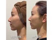 メディカルエース(MedicalAce)/ブライティングリフト