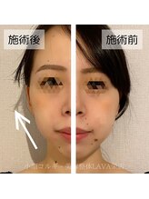 ラバ 名古屋栄店(LAVA)/小顔コルギ【たるみケア】