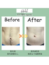 ナガオカ 今朝白店(nagaoka)/お腹の脱毛/BeforeAfter 