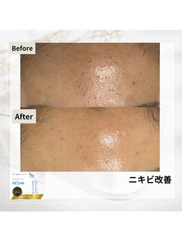 ルアナ(Luana)/セラピールの効果★