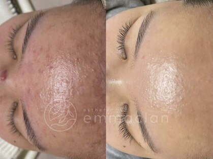 エマクラン(emmaclan)の写真