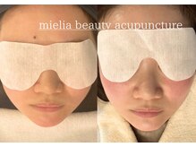 ミエリア美容鍼灸院(mielia美容鍼灸院)の雰囲気（他院で出来ない『小顔と肌質改善』が一度にできます！）