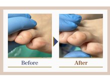 巻き爪補正店 錦糸町店/【タコ・魚の目ケア】