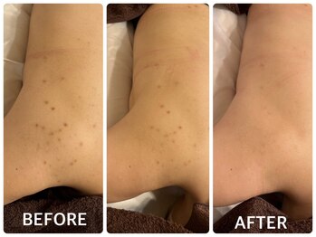 ハーブピーリング 心斎橋/背中ニキビ改善