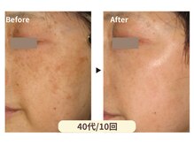 美男美女 奈良三条店/美肌プログラム