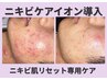 ニキビ肌リセットコース