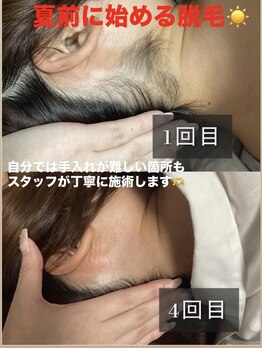 メロスの写真/【エリア挑戦価格★都度払いOK】脱毛の効果重視派に選ばれる脱毛サロン!全身脱毛/メンズ脱毛◎