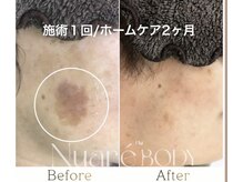 サロンドオール(Salon de Or.)の雰囲気（大きなシミも施術１回とホームケアで、ほとんど見えなく！！）