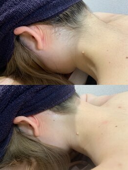 エレナビューティー(Elena Beauty)/うなじ脱毛