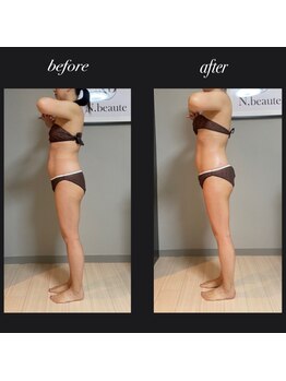 エヌボーテ(N. beaute)/before→after全身コース一回目