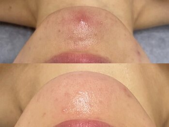 ホーミー(Homie)/ニキビ改善、赤みニキビ改善