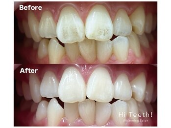 ハイティース 高田馬場店(Hi Teeth!)/医療提携セルフホワイトニング