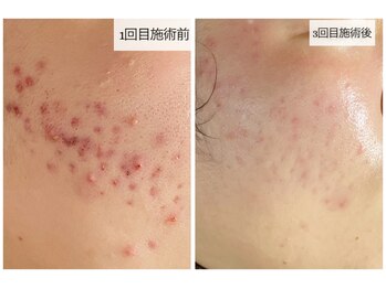 おうちサロン ミキ/繰り返すニキビケア