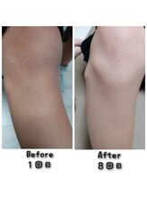 プロジェクトサン ムーンベル(PROjECTSuN Moonbell)/小学生　脱毛(男女)