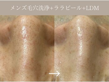 リィ プラス(Riii plus)/【メンズ毛穴洗浄】