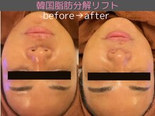 シエスタ(siesta)の雰囲気（温かくて冷たい新感覚のダウンタイムのない韓国脂肪分解リフト。）