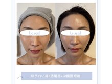 ルソール(Le seul)の雰囲気（1度でこの効果！ヒト幹細胞原液導入で水光肌。インディバ/美容鍼）