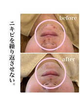 マルコ(marco)/ニキビケア　症例