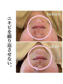 マルコ(marco)/ニキビケア　症例