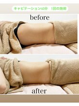 イハナ(IHANA)/キャビテーション1回で変わる