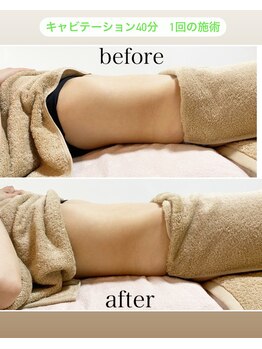 イハナ(IHANA)/キャビテーション1回で変わる