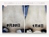 【肌質改善】剥離無し!ダウンタイム無し次世代美背中ハーブピーリング　¥9800