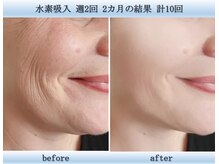 椿 天王寺店(TSUBAKI)/酵素風呂/よもぎ蒸し/水素吸入