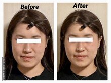 ショウフェイスデザイン(Sho Face Design)/《小顔矯正》ビフォーアフター