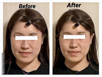 ショウフェイスデザイン(Sho Face Design)/《小顔矯正》ビフォーアフター
