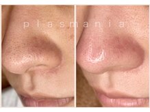 アールスタイルビューティ(R STYLE BEAUTY)/プラズマニア[フェイシャル]毛穴