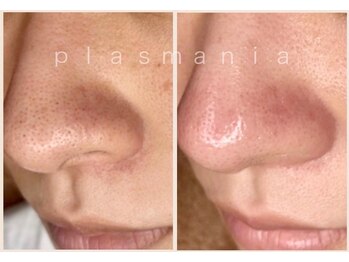 アールスタイルビューティ(R STYLE BEAUTY)/プラズマニア[フェイシャル]毛穴