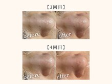 ドリームスパ 武蔵小杉店(DREAM SPA)/毛穴吸引＋引き締めパック＋導入