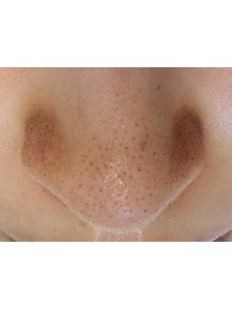 毛穴ケアをしたい