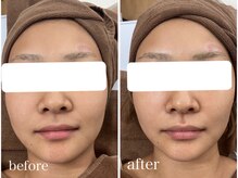 ルポナ(Reposna)/ビフォーアフター