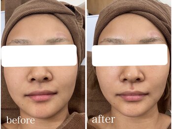 ルポナ(Reposna)/ビフォーアフター