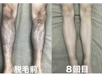 ビューティーサロンレモン(Lemon)/足脱毛