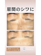 ジヒカ(ZIHICA)/【肌育フルコース】