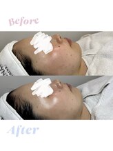 ケセラ(Quesera)&nbsp;人気No.1 白玉肌管理