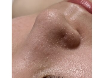 オンド(OND)の写真/ダクトピール/毛穴洗浄/プラズマなどの技術を組み合わせ肌状態に合わせた低刺激な毛穴ケアをご提案します。