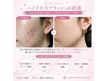 パピコアイラッシュ(papico_eyelash)の雰囲気（月1ケアの毛穴洗浄+美容液導入でニキビができにくい肌に）