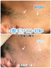 リム 横浜(RIM)/もみあげ脱毛