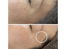 カルディエ(Cardie)/肌質改善　ビフォーアフター