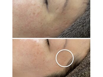 カルディエ(Cardie)/肌質改善　ビフォーアフター