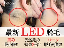 チル(chill)の雰囲気（部分アタッチメントで眉毛、眉間、小鼻など細かな箇所も脱毛可能）