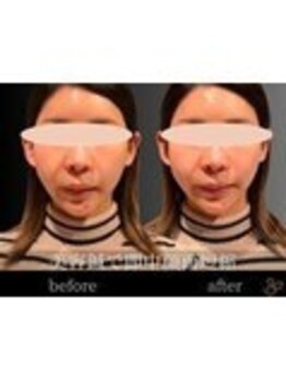 チョコバリ 錦糸町店(chocobari)/小顔×リフトアップ(美容鍼)20代