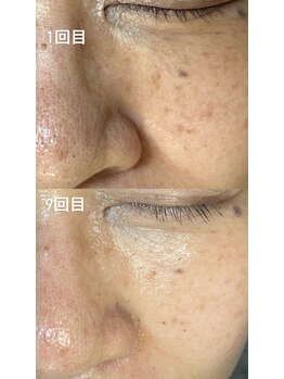 ココ(COCO)/ハーブピーリング→60代のお客様