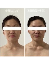 ポラス(Polus)/小顔コルギ