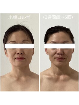 ポラス(Polus)/小顔コルギ